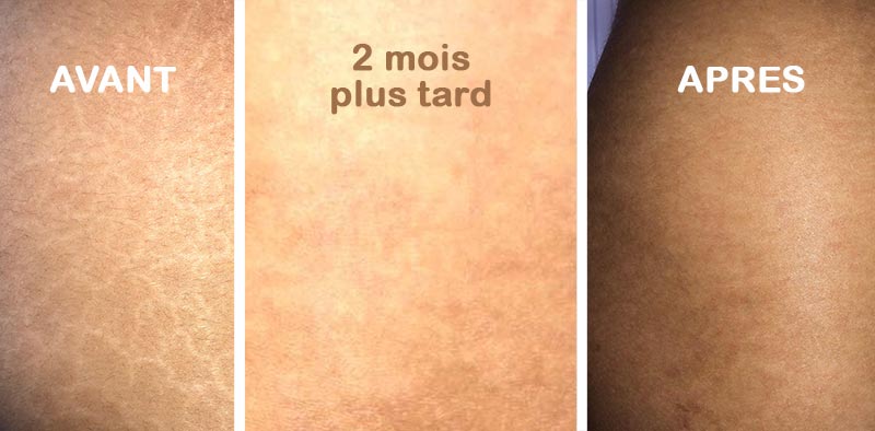 Crème Anti-Cicatrice, vergeture, chéloïde (Bn)