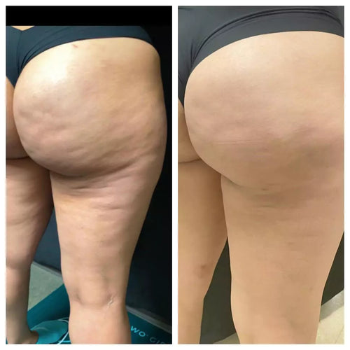 Patch BeautyShan : Ventre Plat-Anti-cellulite