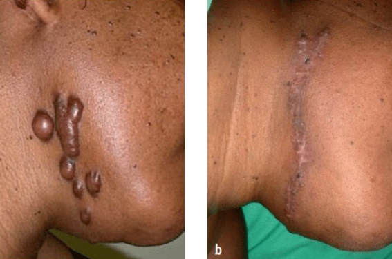 Crème Anti-Cicatrice, vergeture, chéloïde (Bn)