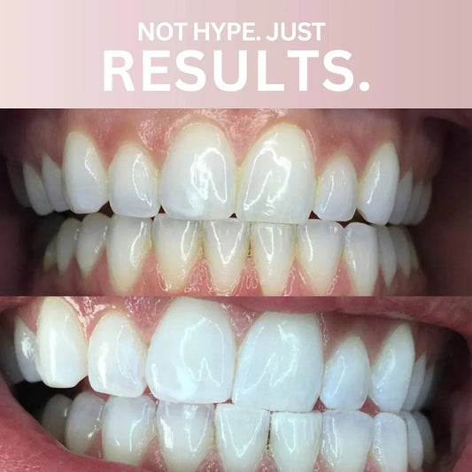 WhiteSmile™ — Bandes de Blanchiment Premiumm